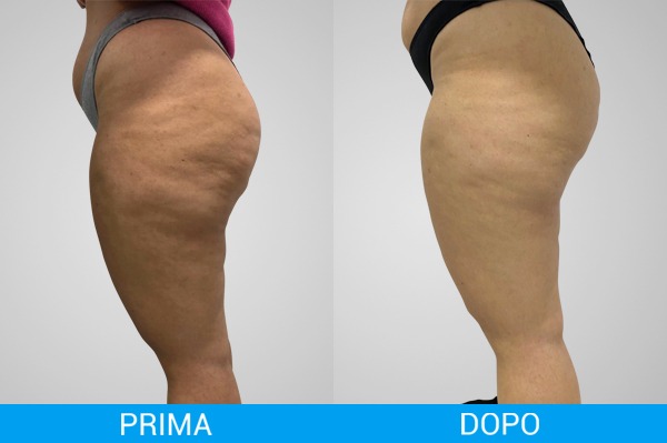 Uno confronto tra il livello di cellulite prima e dopo una seduta di fisioestetica